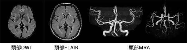 MRI画像